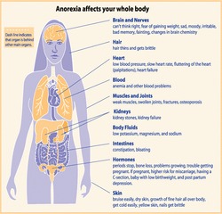 Anorexia Treatment